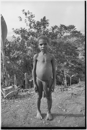 Young boy with swollen stomach, sign of malnutrition