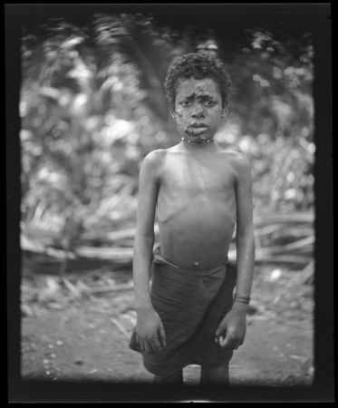Young boy with yaws
