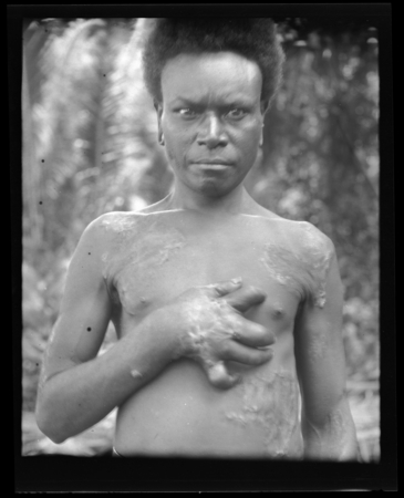 Man with leprosy, probably in Solomon Islands