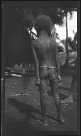 Young boy with Yaws, Guadalcanal